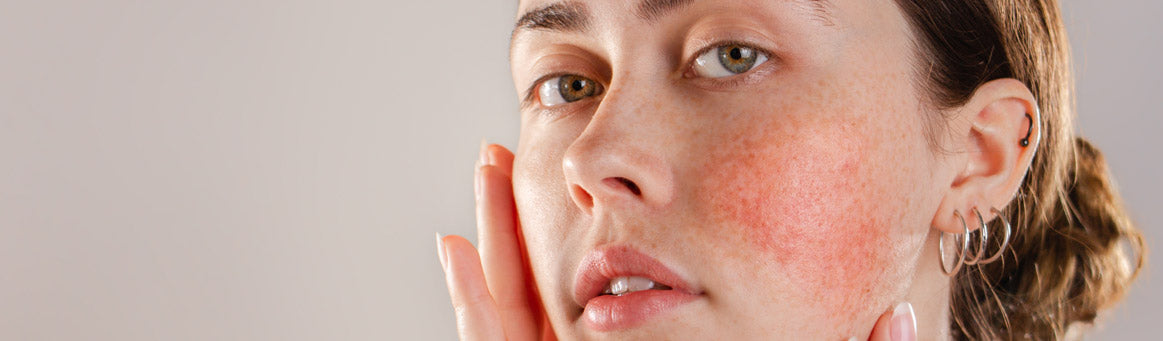 Rosacea